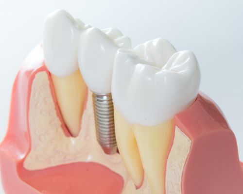 implantes dentales 1